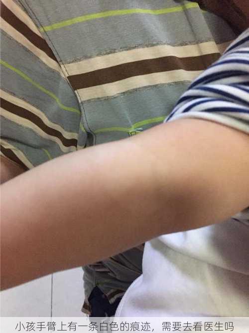 小孩手臂上有一条白色的痕迹，需要去看医生吗