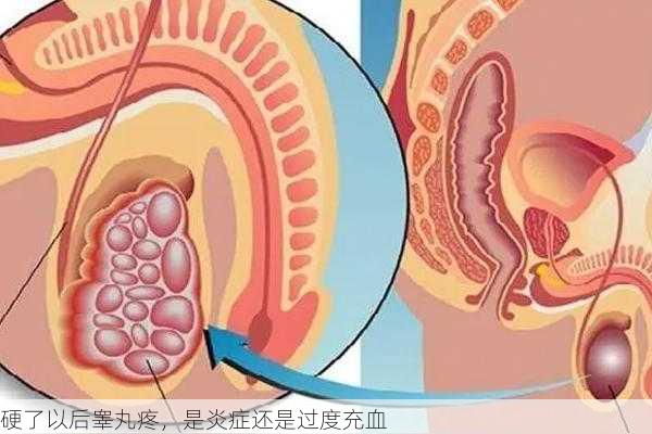 硬了以后睾丸疼，是炎症还是过度充血
